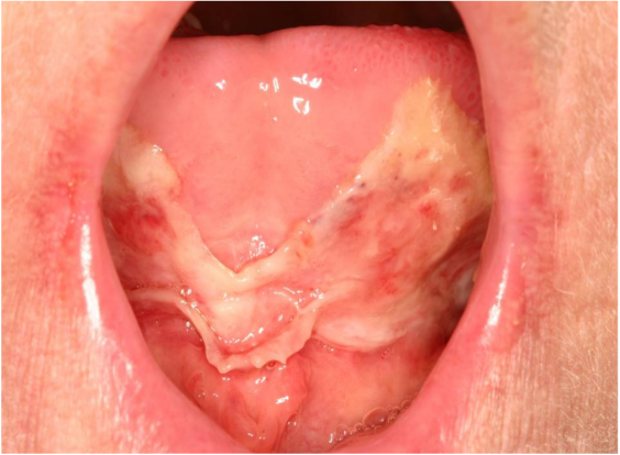 Oral mucositis